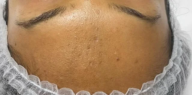 Clearer skin after a course of microneedling