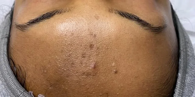 Skin with active acne before treatment